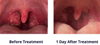 Laser Tonsillectomy